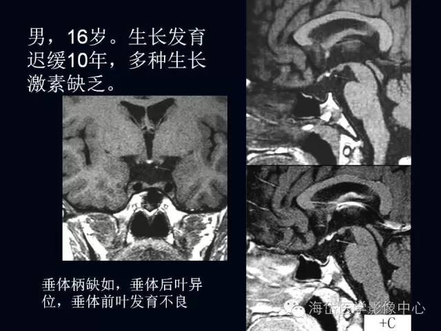 垂体柄阻断综合症MR表现