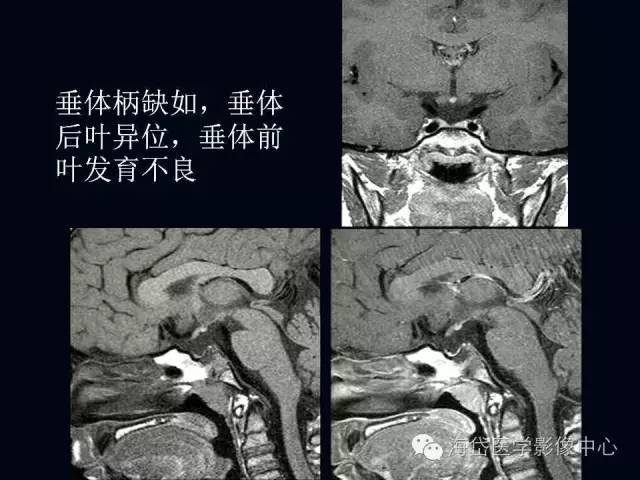 垂体柄阻断综合症MR表现