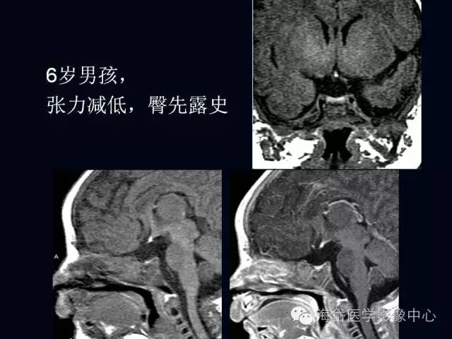 垂体柄阻断综合症MR表现