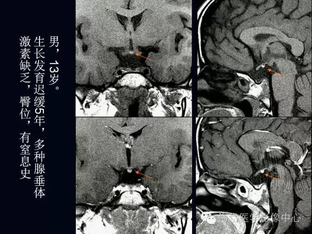 垂体柄阻断综合症MR表现