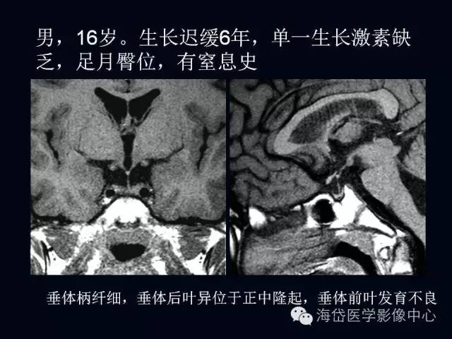 垂体柄阻断综合症MR表现