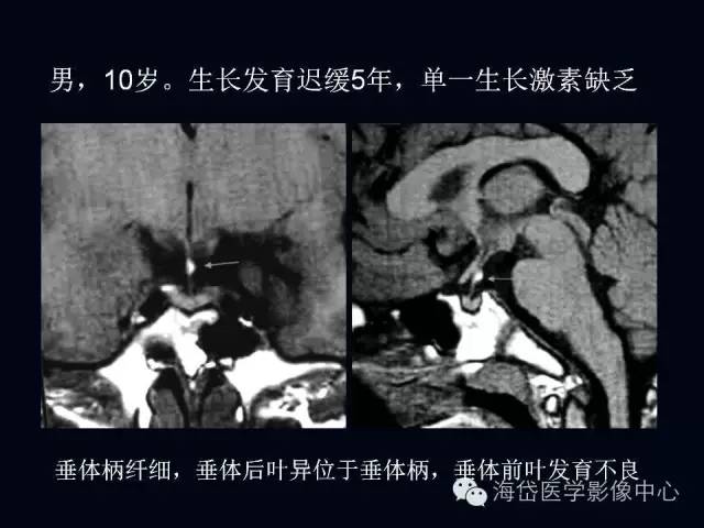 垂体柄阻断综合症MR表现