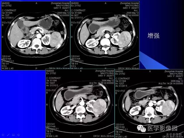 【病例】肾嗜酸细胞腺瘤1例CT影像表现