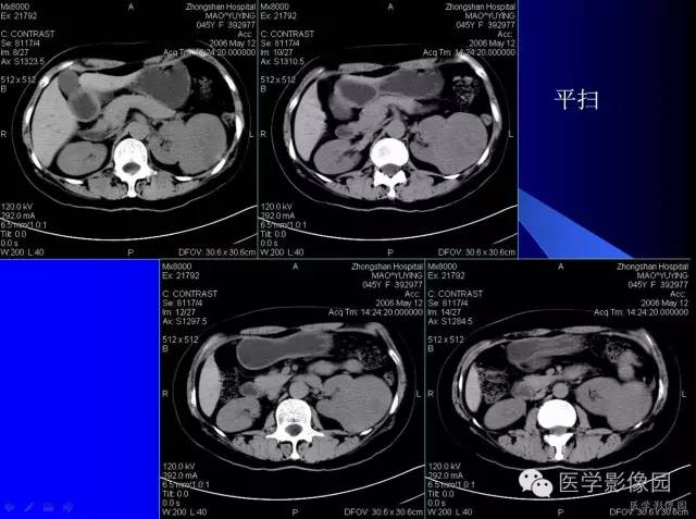 【病例】肾嗜酸细胞腺瘤1例CT影像表现