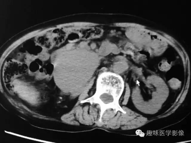 【病例】肾动静脉瘘致下腔静脉瘤样扩张1例CT 【病例】肾动静脉瘘致下腔静脉瘤样扩张1例CT