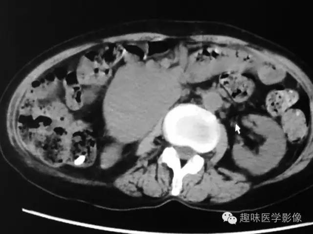 【病例】肾动静脉瘘致下腔静脉瘤样扩张1例CT 【病例】肾动静脉瘘致下腔静脉瘤样扩张1例CT