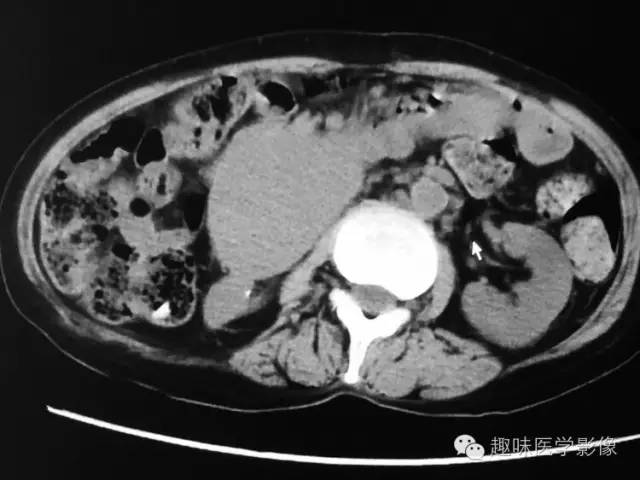 【病例】肾动静脉瘘致下腔静脉瘤样扩张1例CT 【病例】肾动静脉瘘致下腔静脉瘤样扩张1例CT