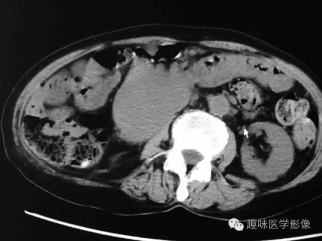 【病例】肾动静脉瘘致下腔静脉瘤样扩张1例CT 【病例】肾动静脉瘘致下腔静脉瘤样扩张1例CT