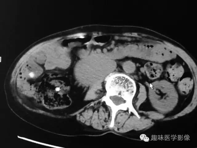 【病例】肾动静脉瘘致下腔静脉瘤样扩张1例CT 【病例】肾动静脉瘘致下腔静脉瘤样扩张1例CT
