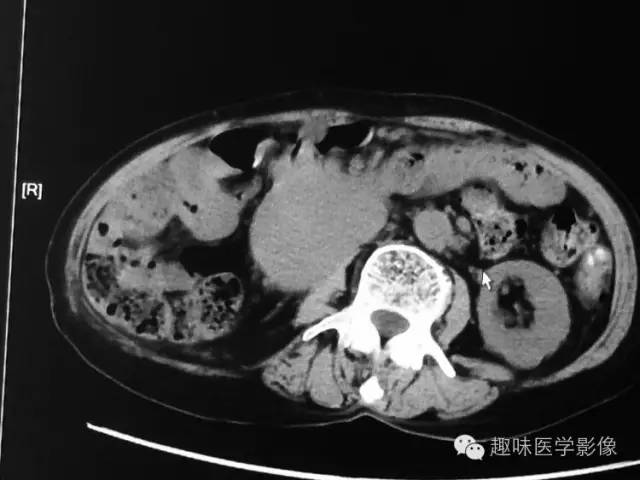 【病例】肾动静脉瘘致下腔静脉瘤样扩张1例CT 【病例】肾动静脉瘘致下腔静脉瘤样扩张1例CT
