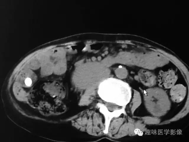 【病例】肾动静脉瘘致下腔静脉瘤样扩张1例CT 【病例】肾动静脉瘘致下腔静脉瘤样扩张1例CT