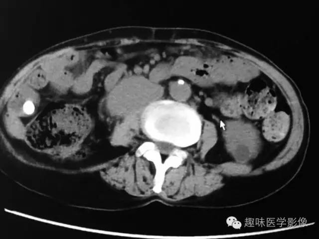 【病例】肾动静脉瘘致下腔静脉瘤样扩张1例CT 【病例】肾动静脉瘘致下腔静脉瘤样扩张1例CT