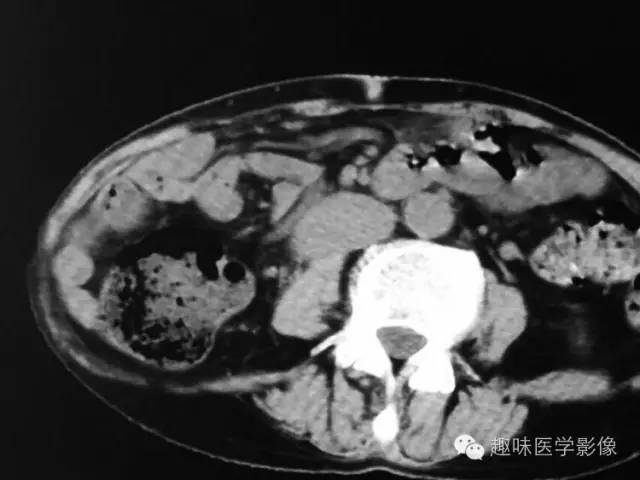 【病例】肾动静脉瘘致下腔静脉瘤样扩张1例CT 【病例】肾动静脉瘘致下腔静脉瘤样扩张1例CT