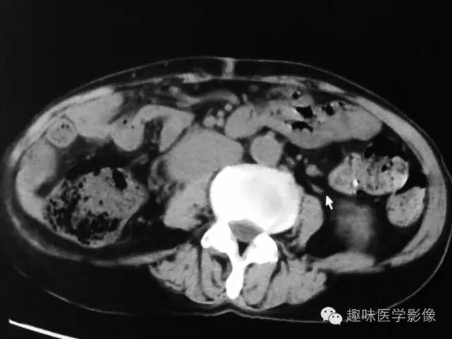 【病例】肾动静脉瘘致下腔静脉瘤样扩张1例CT 【病例】肾动静脉瘘致下腔静脉瘤样扩张1例CT