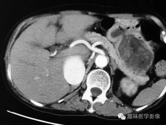 【病例】肾动静脉瘘致下腔静脉瘤样扩张1例CT 【病例】肾动静脉瘘致下腔静脉瘤样扩张1例CT