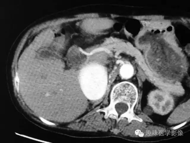【病例】肾动静脉瘘致下腔静脉瘤样扩张1例CT 【病例】肾动静脉瘘致下腔静脉瘤样扩张1例CT