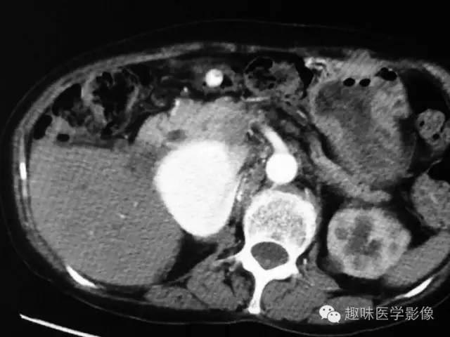 【病例】肾动静脉瘘致下腔静脉瘤样扩张1例CT 【病例】肾动静脉瘘致下腔静脉瘤样扩张1例CT