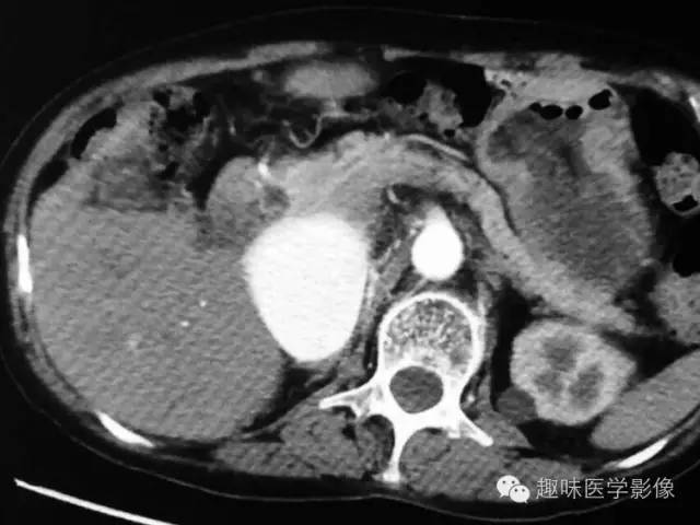 【病例】肾动静脉瘘致下腔静脉瘤样扩张1例CT 【病例】肾动静脉瘘致下腔静脉瘤样扩张1例CT