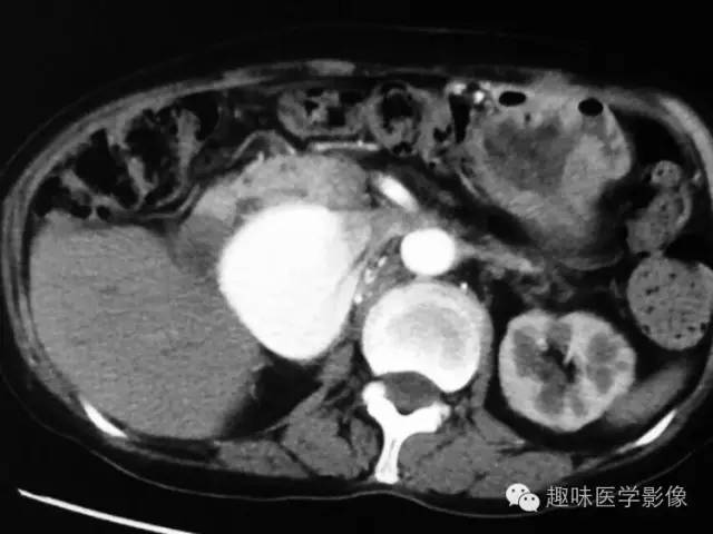 【病例】肾动静脉瘘致下腔静脉瘤样扩张1例CT