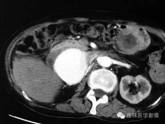 【病例】肾动静脉瘘致下腔静脉瘤样扩张1例CT 【病例】肾动静脉瘘致下腔静脉瘤样扩张1例CT