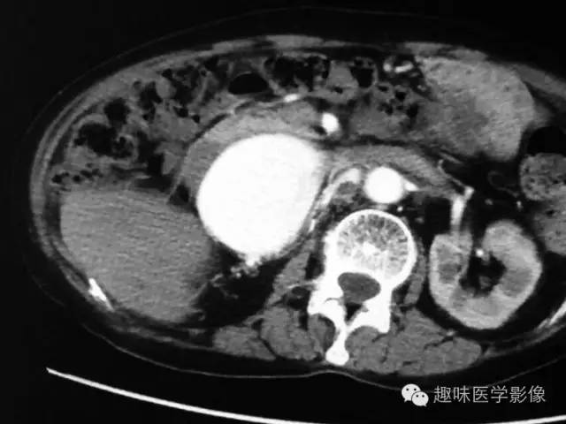【病例】肾动静脉瘘致下腔静脉瘤样扩张1例CT 【病例】肾动静脉瘘致下腔静脉瘤样扩张1例CT