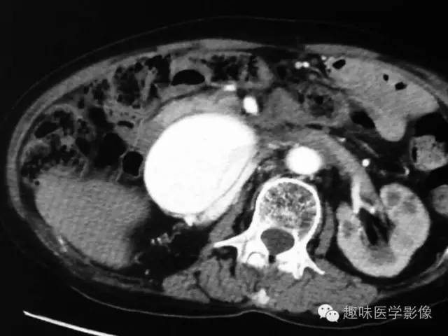 【病例】肾动静脉瘘致下腔静脉瘤样扩张1例CT 【病例】肾动静脉瘘致下腔静脉瘤样扩张1例CT