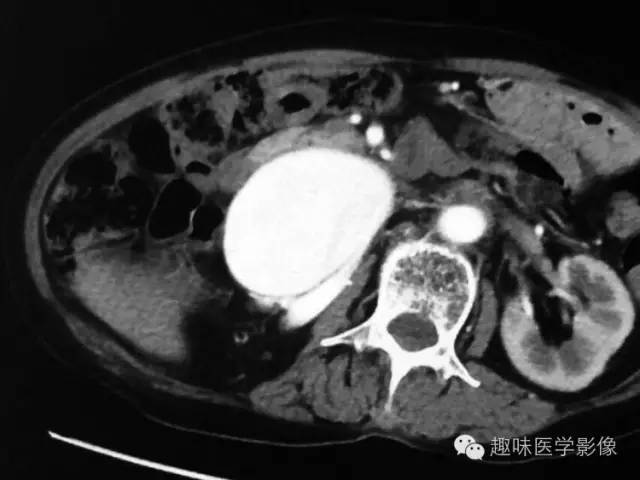 【病例】肾动静脉瘘致下腔静脉瘤样扩张1例CT 【病例】肾动静脉瘘致下腔静脉瘤样扩张1例CT