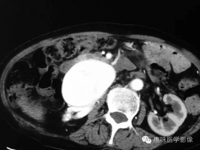【病例】肾动静脉瘘致下腔静脉瘤样扩张1例CT 【病例】肾动静脉瘘致下腔静脉瘤样扩张1例CT