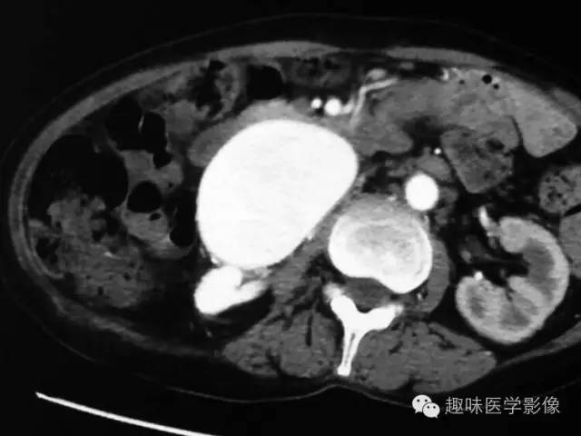 【病例】肾动静脉瘘致下腔静脉瘤样扩张1例CT 【病例】肾动静脉瘘致下腔静脉瘤样扩张1例CT