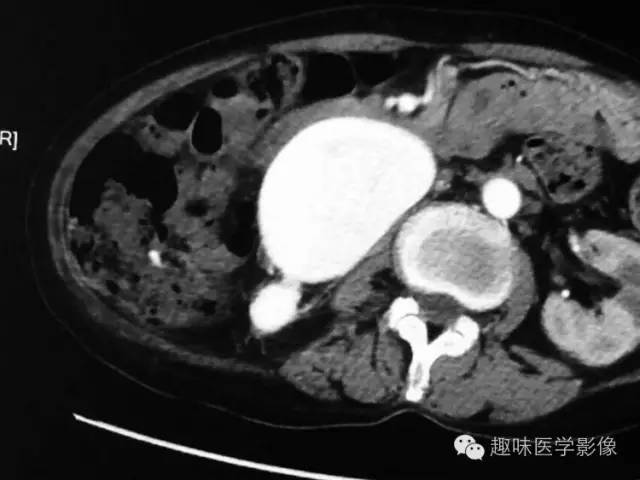 【病例】肾动静脉瘘致下腔静脉瘤样扩张1例CT 【病例】肾动静脉瘘致下腔静脉瘤样扩张1例CT
