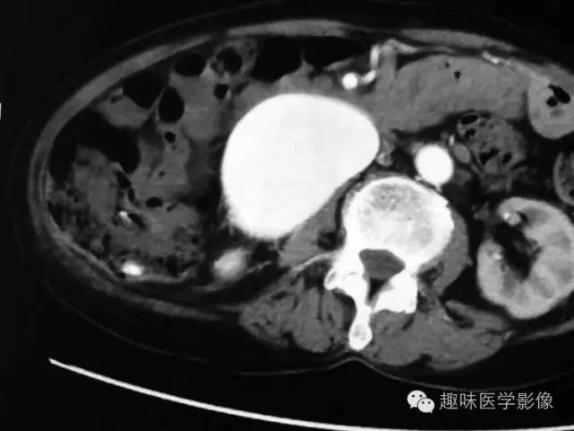 【病例】肾动静脉瘘致下腔静脉瘤样扩张1例CT 【病例】肾动静脉瘘致下腔静脉瘤样扩张1例CT