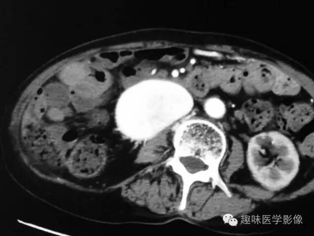【病例】肾动静脉瘘致下腔静脉瘤样扩张1例CT 【病例】肾动静脉瘘致下腔静脉瘤样扩张1例CT
