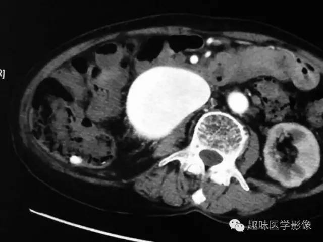 【病例】肾动静脉瘘致下腔静脉瘤样扩张1例CT 【病例】肾动静脉瘘致下腔静脉瘤样扩张1例CT