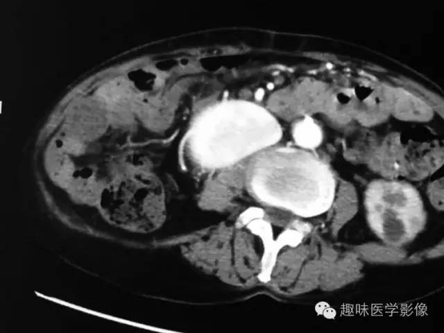 【病例】肾动静脉瘘致下腔静脉瘤样扩张1例CT 【病例】肾动静脉瘘致下腔静脉瘤样扩张1例CT