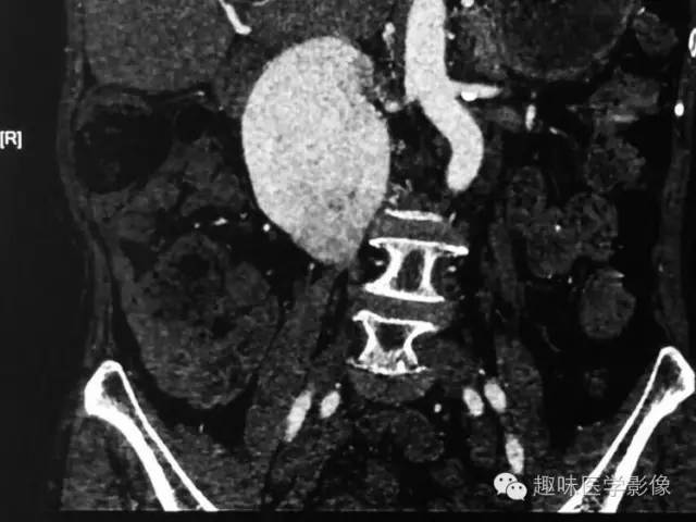 【病例】肾动静脉瘘致下腔静脉瘤样扩张1例CT 【病例】肾动静脉瘘致下腔静脉瘤样扩张1例CT