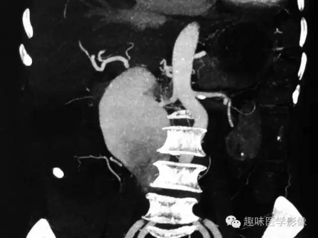 【病例】肾动静脉瘘致下腔静脉瘤样扩张1例CT 【病例】肾动静脉瘘致下腔静脉瘤样扩张1例CT