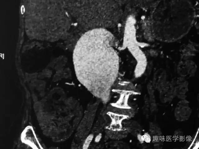 【病例】肾动静脉瘘致下腔静脉瘤样扩张1例CT 【病例】肾动静脉瘘致下腔静脉瘤样扩张1例CT