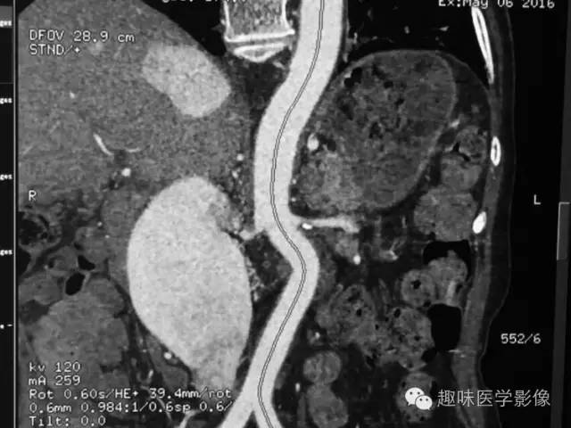 【病例】肾动静脉瘘致下腔静脉瘤样扩张1例CT 【病例】肾动静脉瘘致下腔静脉瘤样扩张1例CT