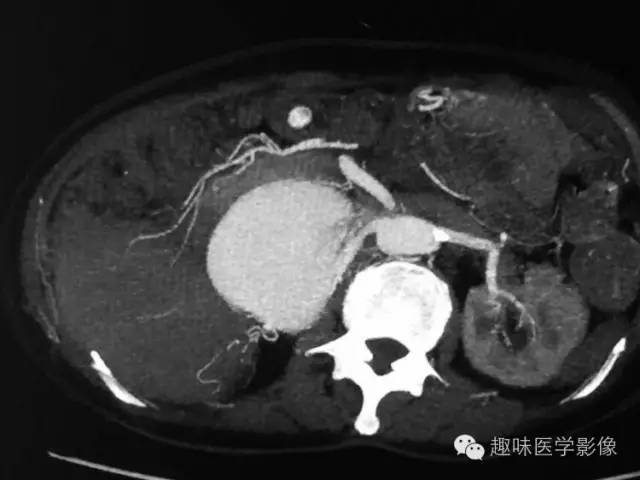 【病例】肾动静脉瘘致下腔静脉瘤样扩张1例CT 【病例】肾动静脉瘘致下腔静脉瘤样扩张1例CT