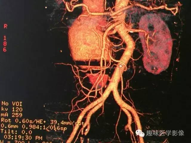 【病例】肾动静脉瘘致下腔静脉瘤样扩张1例CT 【病例】肾动静脉瘘致下腔静脉瘤样扩张1例CT