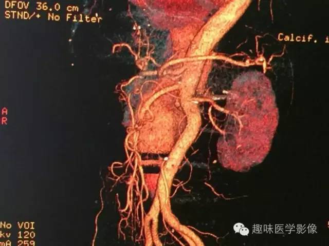 【病例】肾动静脉瘘致下腔静脉瘤样扩张1例CT 【病例】肾动静脉瘘致下腔静脉瘤样扩张1例CT