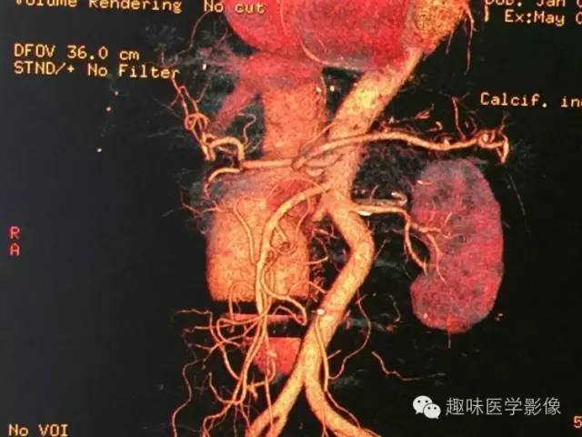 【病例】肾动静脉瘘致下腔静脉瘤样扩张1例CT 【病例】肾动静脉瘘致下腔静脉瘤样扩张1例CT