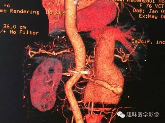 【病例】肾动静脉瘘致下腔静脉瘤样扩张1例CT 【病例】肾动静脉瘘致下腔静脉瘤样扩张1例CT