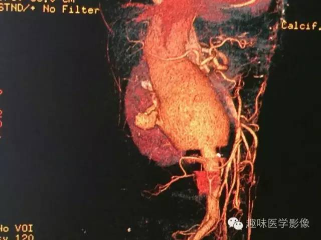 【病例】肾动静脉瘘致下腔静脉瘤样扩张1例CT 【病例】肾动静脉瘘致下腔静脉瘤样扩张1例CT