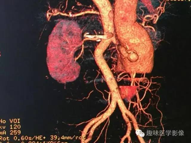【病例】肾动静脉瘘致下腔静脉瘤样扩张1例CT 【病例】肾动静脉瘘致下腔静脉瘤样扩张1例CT
