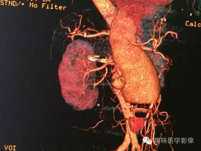 【病例】肾动静脉瘘致下腔静脉瘤样扩张1例CT 【病例】肾动静脉瘘致下腔静脉瘤样扩张1例CT