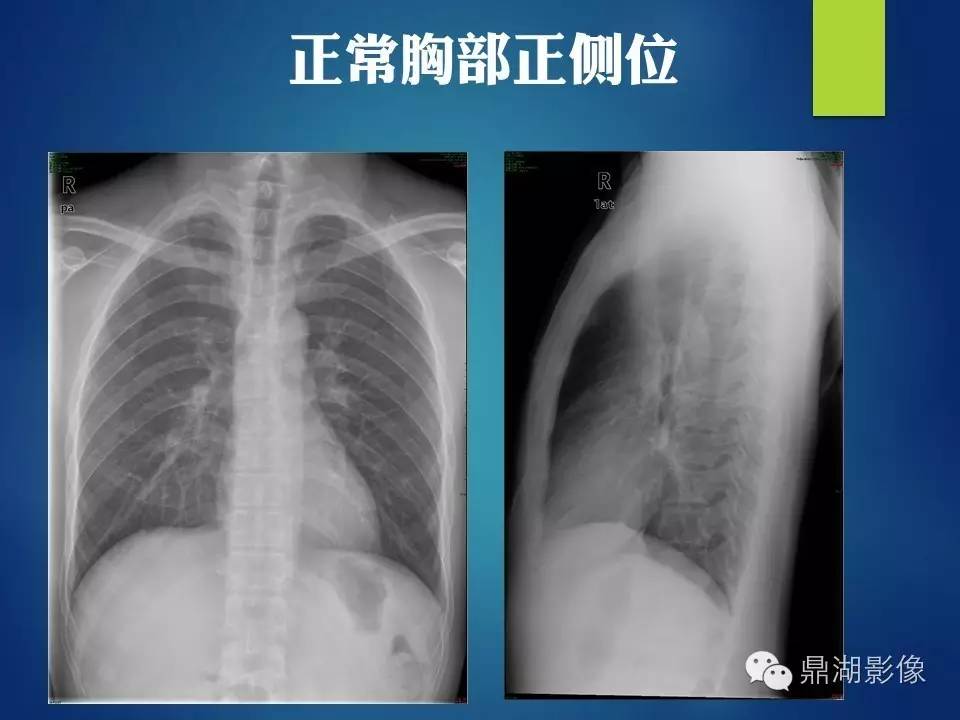 40例典型胸片