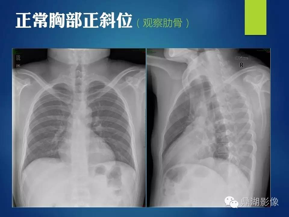 40例典型胸片