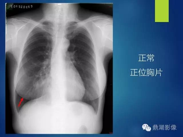 40例典型胸片
