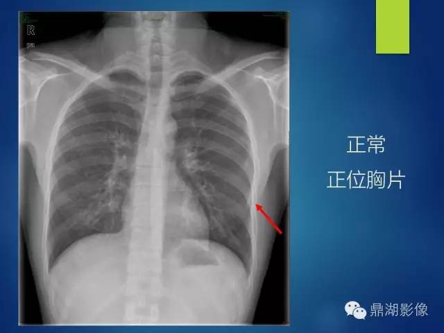 40例典型胸片